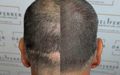 QUE HACER CON ESA CICATRIZ PARA DISIMULARLA DE MI LOOK?