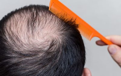 LA CAIDA DEL CABELLO ¿POR QUÉ?