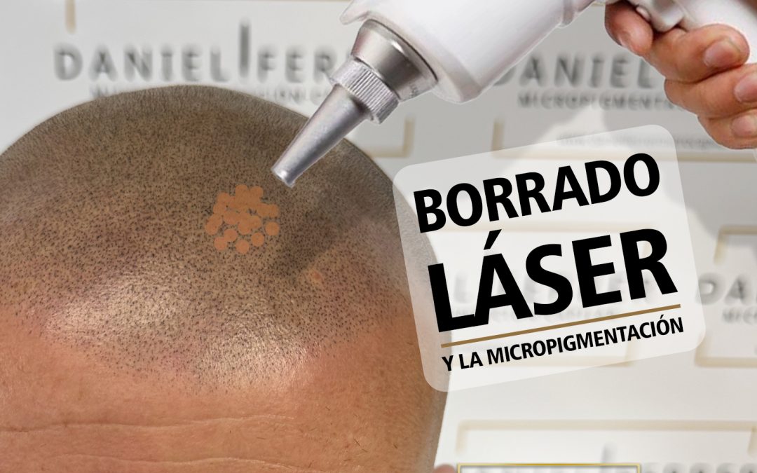 Aumento de tratamientos de borrado láser tras micropigmentación capilar mal realizada: por qué es imprescindible elegir un centro cualificad