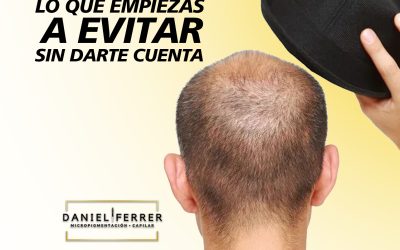 El problema no es la calvicie