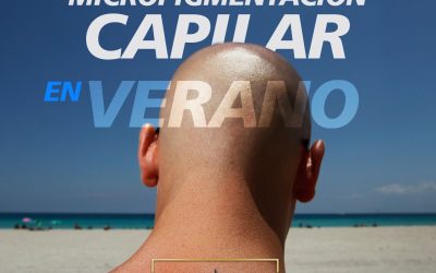 Micropigmentación capilar en verano: el mejor momento para recuperar tu imagen y disfrutar sin complejos