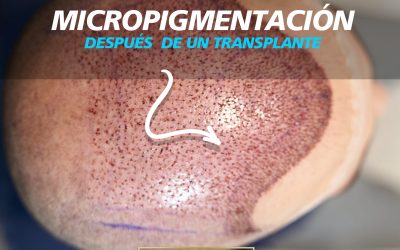 Micropigmentación capilar después de un trasplante: cuándo puede mejorar el resultado