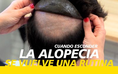 Cuando esconder la alopecia se convierte en parte de tu rutina: el cambio de estrategia