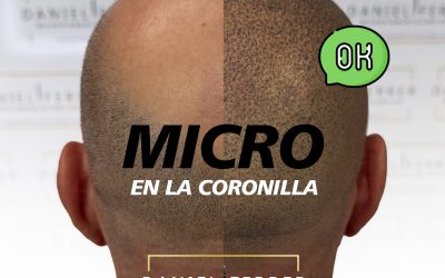 Micropigmentación capilar en la coronilla: cómo mejorar visualmente una zona difícil