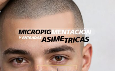 Micropigmentación capilar y entradas asimétricas: cómo conseguir un resultado equilibrado